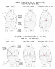 ACL TEARS AND SPRAINS TREATMENT OPTIONS