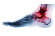 ANKLE ARTHRITIS SYMPTOMS AND TREATMENT