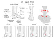ANKLE SPRAIN SYMPTOMS AND TREATMENT