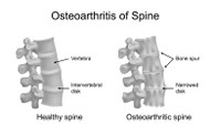 FACET ARTHROPATHY (SPINE ARTHRITIS) SYMPTOMS AND TREATMENT