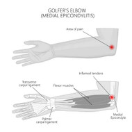 GOLFER'S ELBOW CAUSES AND PAIN RELIEF