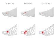 HAMMER TOE CAUSES, SYMPTOMS, AND TREATMENT