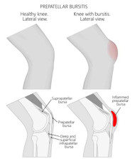 KNEE BURSITIS CAUSES AND PAIN RELIEF OPTIONS