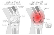 KNEE JOINT SWELLING CAUSES AND SOLUTIONS