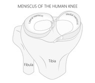 WHAT IS THE BEST KNEE BRACE FOR A MENISCUS TEAR?