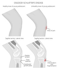  OSGOOD -SCHLATTER DISEASE CAUSES AND PAIN RELIEF