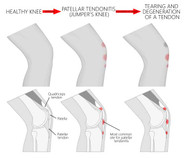 PATELLAR TENDONITIS CAUSES AND SOLUTIONS