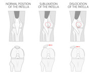 PATELLA TRACKING DISORDER CAUSES AND SOLUTIONS