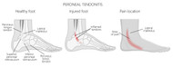 PERONEAL TENDONITIS, STRAINS, AND TEARS TREATMENT