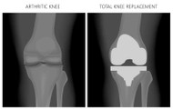 POST KNEE SURGERY INFORMATION AND BRACES