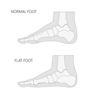 PTTD, POST-TIB TENDONITIS, OR FLAT FOOT TREATMENT