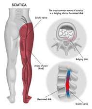 SCIATICA CAUSES, SYMPTOMS, AND TREATMENT