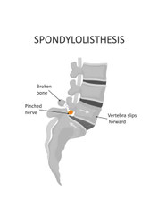 SPONDYLOLISTHESIS SYMPTOMS AND TREATMENT