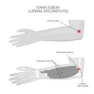 TENNIS ELBOW CAUSES AND PAIN RELIEF