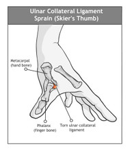 THUM SPRAIN AND SKIER'S THUMB CAUSES AND SOLUTIONS