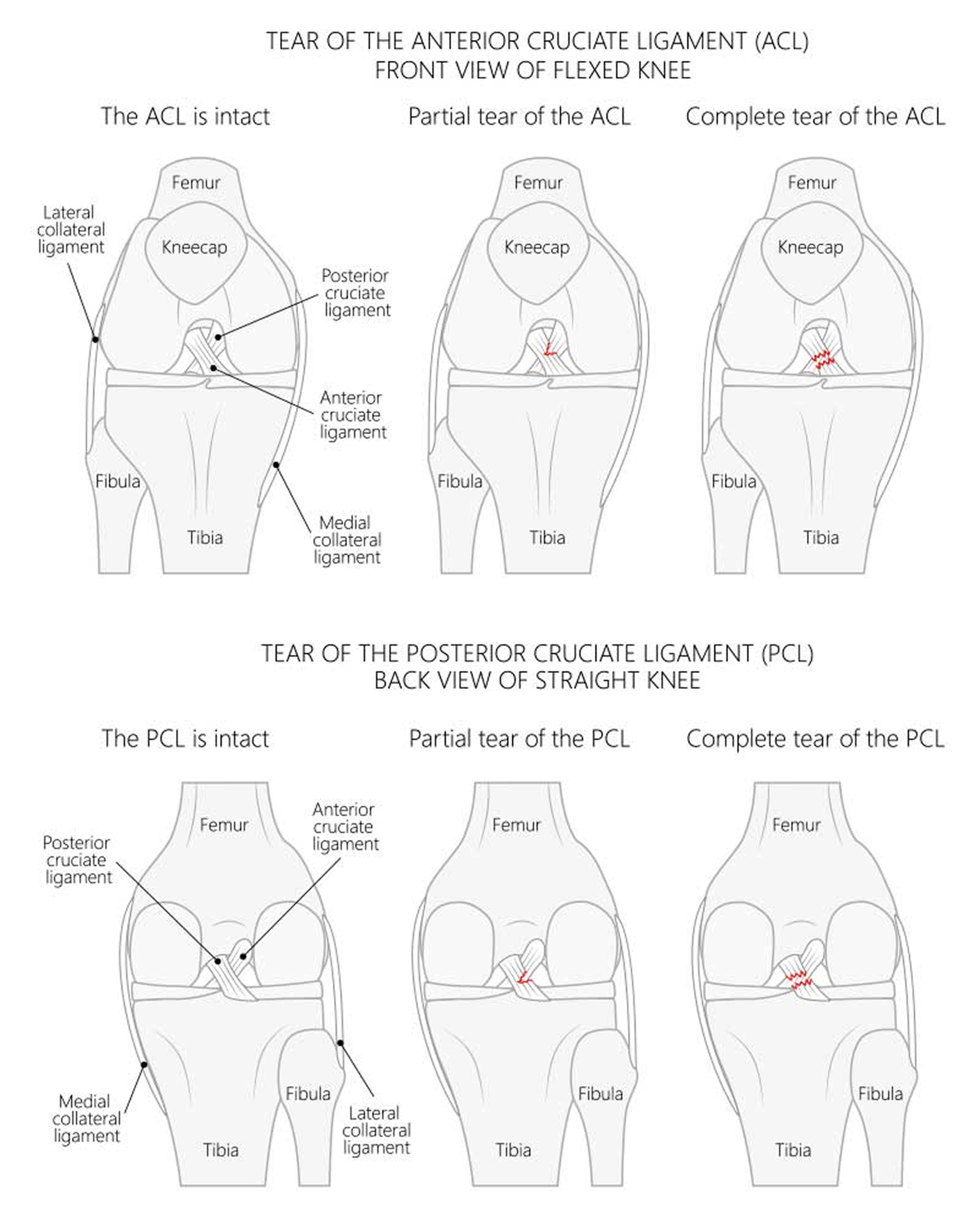 ACL Tears and Sprains: Treatment and Recovery Options