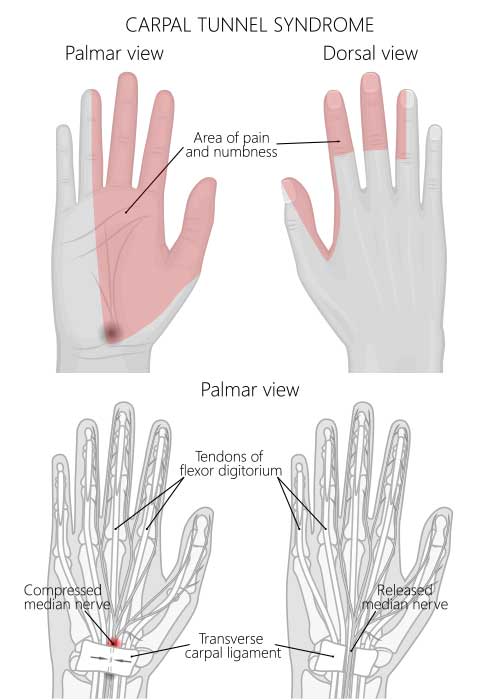 Carpal Tunnel Syndrome: Causes, Symptoms & Relief