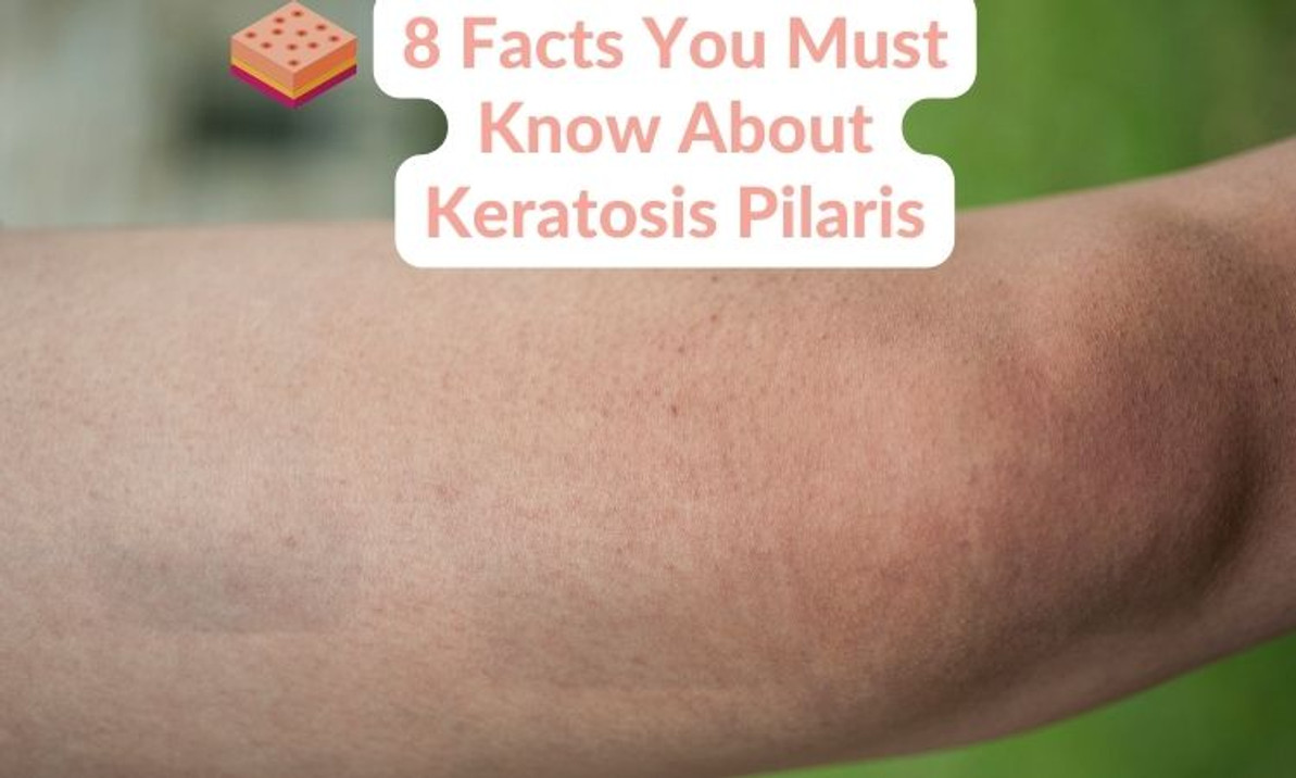 keratosis pilaris under eyes