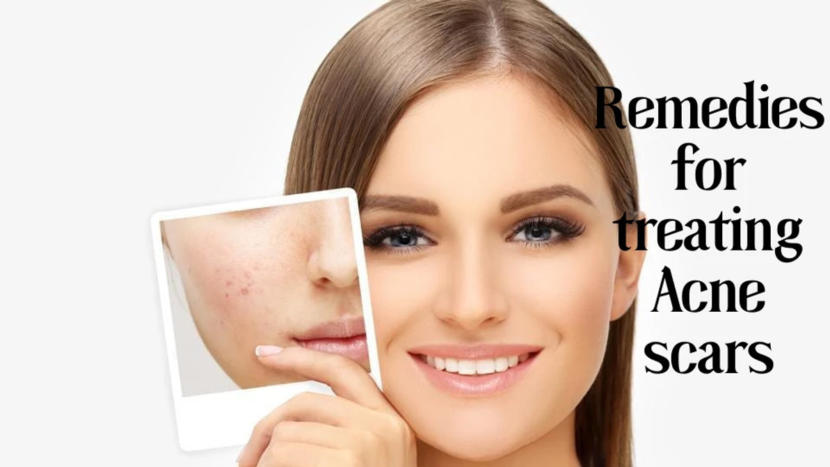 Remedies for Treating Acne Scars Remedies for Treating Acne Scars