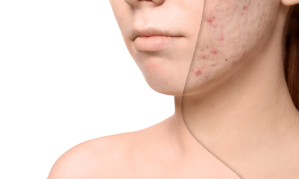 How To Get Rid Of Acne Scars At Home Fast How To Get Rid Of Acne Scars At Home Fast