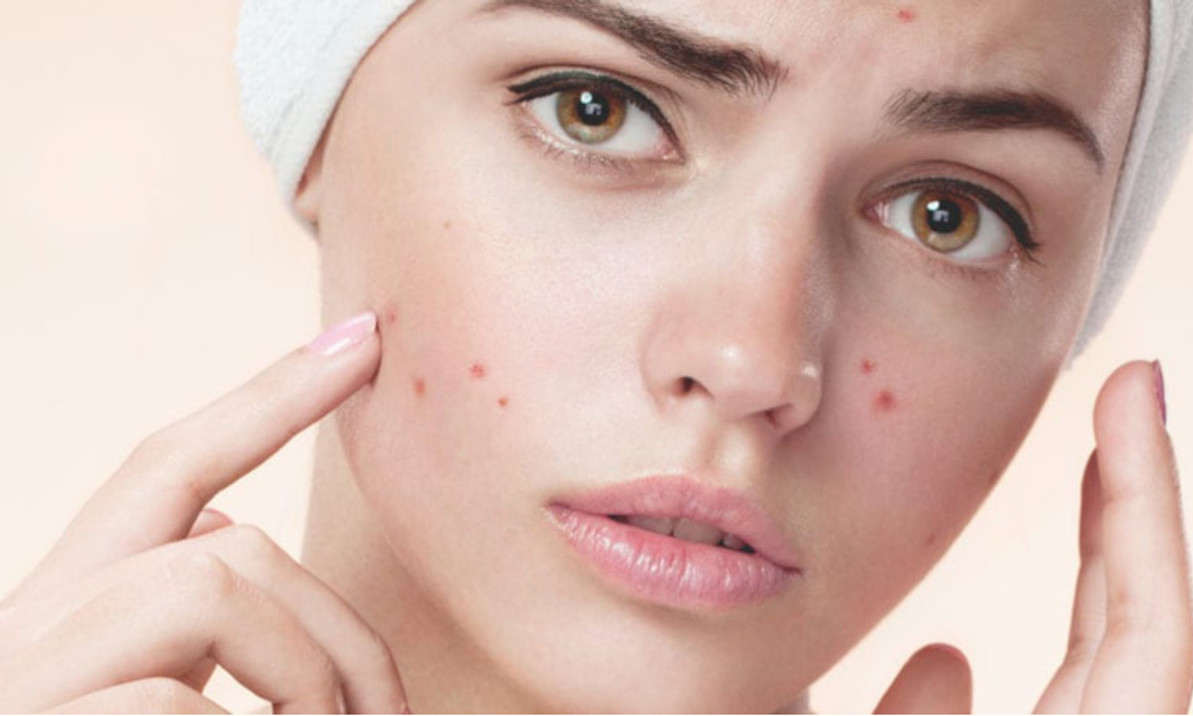 These Skin Care Mistakes Can Cause Acne And Breakouts In Summer - Skin ...