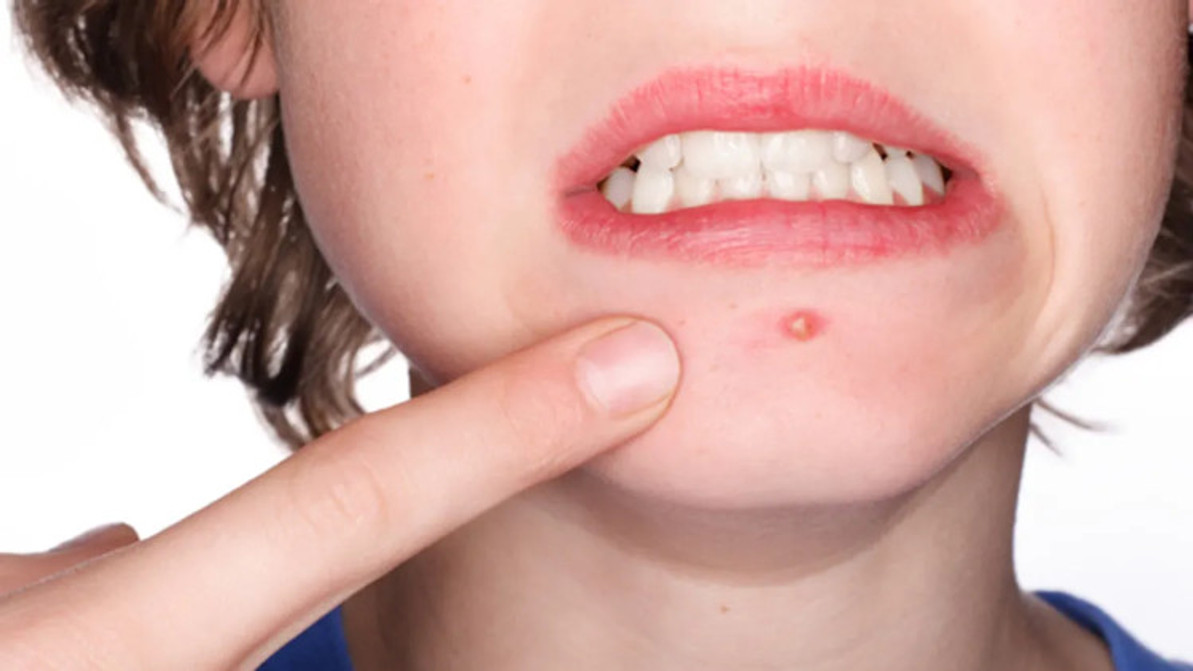 How To Get Rid of A Cystic Pimple Fast How To Get Rid of A Cystic Pimple Fast