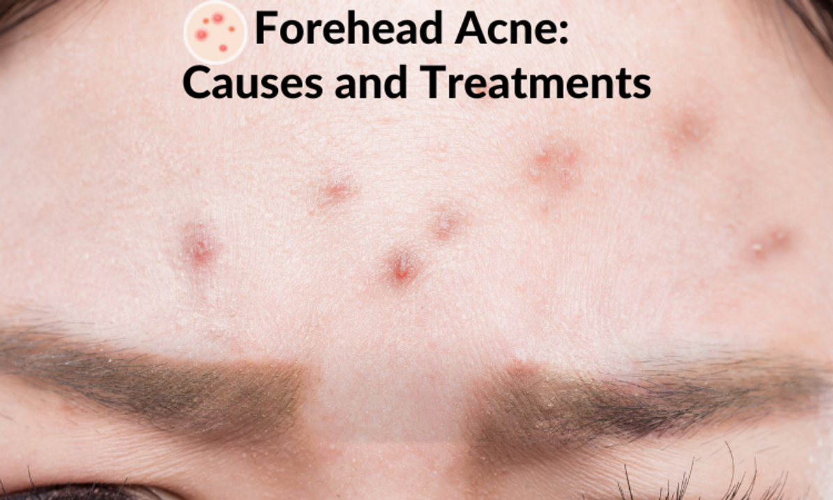 mild acne on forehead