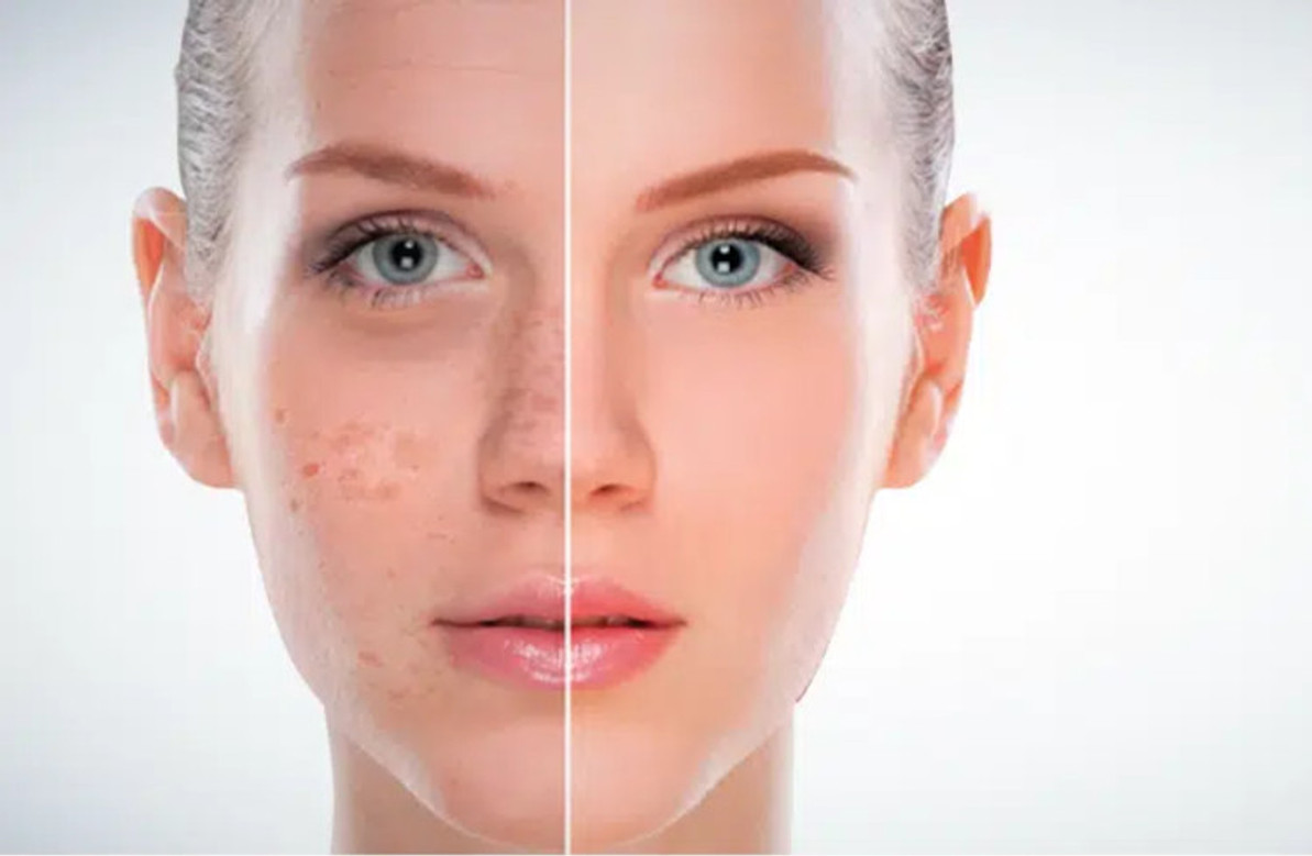 How To Treat Dark Spots On Your Face Skin Beauty how-to-treat-dark-spots-on-your-face-skin-beauty