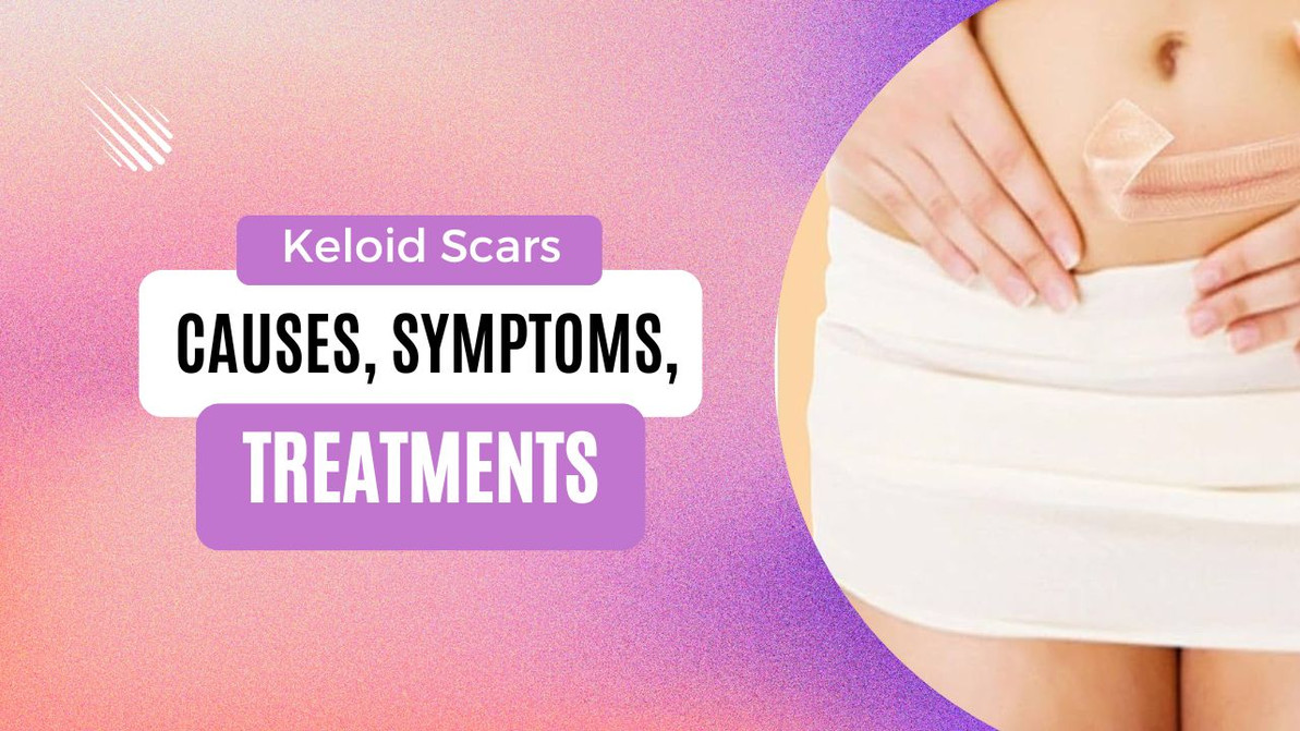 Keloid Scars