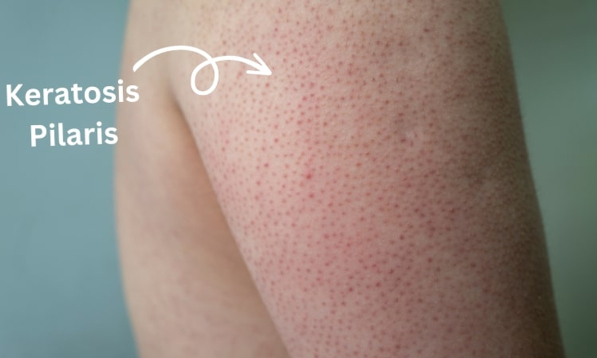 How to Treat Keratosis Pilaris with the Right Skincare Products