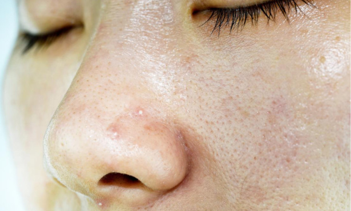 Best Oily Skin Regimen For Shine-Free Complexion Best Oily Skin Regimen For Shine-Free Complexion