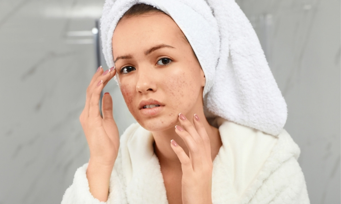 Tips for Treating and Preventing Acne Scarring Tips for Treating and Preventing Acne Scarring