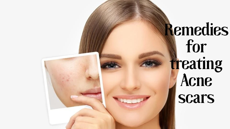 Remedies For Treating Acne Scars Skin Beauty