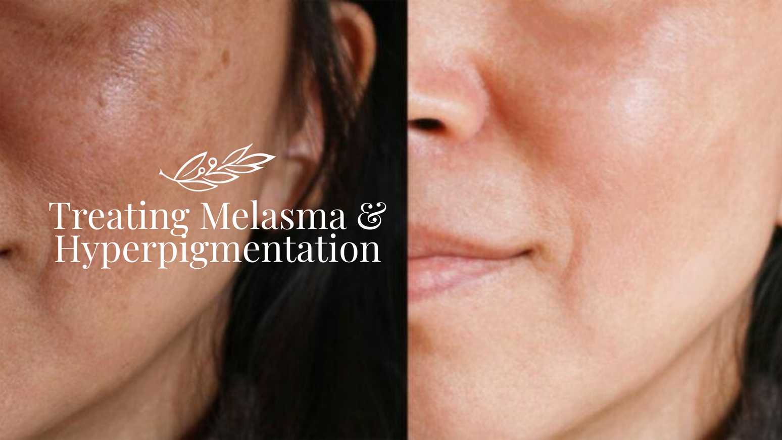 Treating Melasma & Hyperpigmentation with Cimel Professional Peels