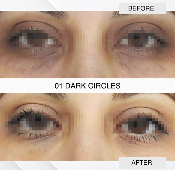 Dark Circles
