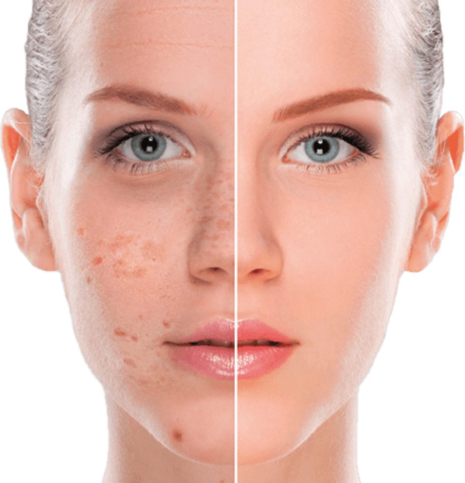 Hyperpigmentation Peel Treatment Downtown Toronto