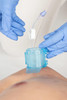 Prometheus PIN ® Intraosseous Needle (IO) Prometheus PIN ® Intraosseous Needle (IO)