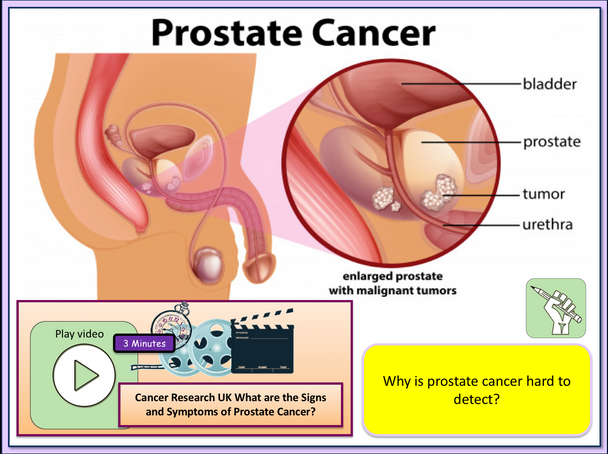 Testicular Cancer  + Prostate Cancer