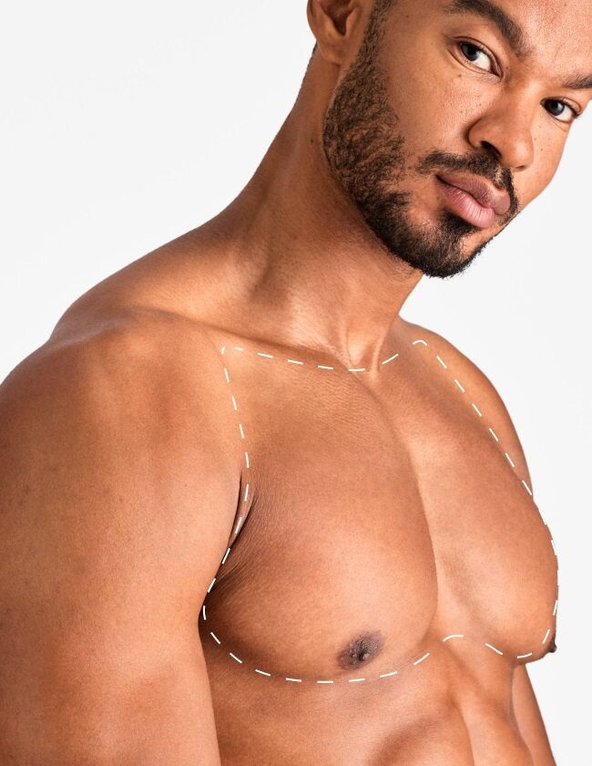 Chest Laser Hair Removal Laser Clinics New Zealand