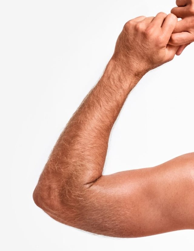 arm pain after melanotan & Tanning Injections: Safe or Risky? Abnormal moles seen developing in