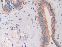 DAB staining on IHC-P; Samples: Human Bile duct cancer Tissue; Primary Ab: 30µg/ml Mouse Anti-Human CAMP Antibody Second Ab: 2µg/mL HRP-Linked Caprine Anti-Mouse IgG Polyclonal Antibody