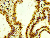 IHC image of RAC07106 diluted at 1:100 and staining in paraffin-embedded human colon cancer performed on a Leica BondTM system. After dewaxing and hydration, antigen retrieval was mediated by high pressure in a citrate buffer (pH 6.0). Section was blocked with 10% normal goat serum 30min at RT. Then primary antibody (1% BSA) was incubated at 4? overnight. The primary is detected by a biotinylated secondary antibody and visualized using an HRP conjugated SP system.