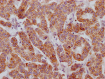 IHC image of RAC07124 diluted at 1:100 and staining in paraffin-embedded human breast cancer performed on a Leica BondTM system. After dewaxing and hydration, antigen retrieval was mediated by high pressure in a citrate buffer (pH 6.0). Section was blocked with 10% normal goat serum 30min at RT. Then primary antibody (1% BSA) was incubated at 4? overnight. The primary is detected by a Goat anti-rabbit IgG polymer labeled by HRP and visualized using 0.05% DAB.
