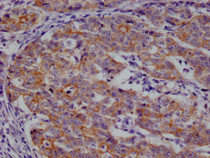 IHC image of RAC07268 diluted at 1:100 and staining in paraffin-embedded human colon cancer performed on a Leica BondTM system. After dewaxing and hydration, antigen retrieval was mediated by high pressure in a citrate buffer (pH 6.0). Section was blocked with 10% normal goat serum 30min at RT. Then primary antibody (1% BSA) was incubated at 4°C overnight. The primary is detected by a Goat anti-rabbit polymer IgG labeled by HRP and visualized using 0.05% DAB.