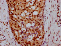IHC image of RAC07275 diluted at 1:100 and staining in paraffin-embedded human breast cancer performed on a Leica BondTM system. After dewaxing and hydration, antigen retrieval was mediated by high pressure in a citrate buffer (pH 6.0). Section was blocked with 10% normal goat serum 30min at RT. Then primary antibody (1% BSA) was incubated at 4? overnight. The primary is detected by a Goat anti-rabbit IgG polymer labeled by HRP and visualized using 0.05% DAB.