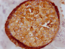 IHC image of RAC07302 diluted at 1:100 and staining in paraffin-embedded human breast cancer performed on a Leica BondTM system. After dewaxing and hydration, antigen retrieval was mediated by high pressure in a citrate buffer (pH 6.0). Section was blocked with 10% normal goat serum 30min at RT. Then primary antibody (1% BSA) was incubated at 4? overnight. The primary is detected by a Goat anti-rabbit IgG polymer labeled by HRP and visualized using 0.05% DAB.