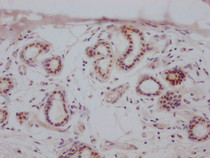 IHC image of RAC07316 diluted at 1:100 and staining in paraffin-embedded human breast cancer performed on a Leica BondTM system. After dewaxing and hydration, antigen retrieval was mediated by high pressure in a citrate buffer (pH 6.0). Section was blocked with 10% normal goat serum 30min at RT. Then primary antibody (1% BSA) was incubated at 4? overnight. The primary is detected by a Goat anti-rabbit IgG polymer labeled by HRP and visualized using 0.05% DAB.
