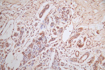 IHC image diluted at 1:600 and staining in paraffin-embedded human breast cancer performed on a Leica BondTM system. After dewaxing and hydration, antigen retrieval was mediated by high pressure in a citrate buffer (pH 6.0). Section was blocked with 10% normal goat serum 30min at RT. Then primary antibody (1% BSA) was incubated at 4°C overnight. The primary is detected by a Goat anti-Mouse IgG labeled by HRP and visualized using 0.05% DAB.