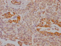IHC image of RAC07332 diluted at 1:100 and staining in paraffin-embedded human pancreatic tissue performed on a Leica BondTM system. After dewaxing and hydration, antigen retrieval was mediated by high pressure in a citrate buffer (pH 6.0). Section was blocked with 10% normal goat serum 30min at RT. Then primary antibody (1% BSA) was incubated at 4? overnight. The primary is detected by a Goat anti-rabbit IgG polymer labeled by HRP and visualized using 0.05% DAB.