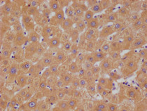 IHC image of RAC07395 diluted at 1:100 and staining in paraffin-embedded human liver cancer performed on a Leica BondTM system. After dewaxing and hydration, antigen retrieval was mediated by high pressure in a citrate buffer (pH 6.0). Section was blocked with 10% normal goat serum 30min at RT. Then primary antibody (1% BSA) was incubated at 4°C overnight. The primary is detected by a Goat anti-rabbit polymer IgG labeled by HRP and visualized using 0.05% DAB.